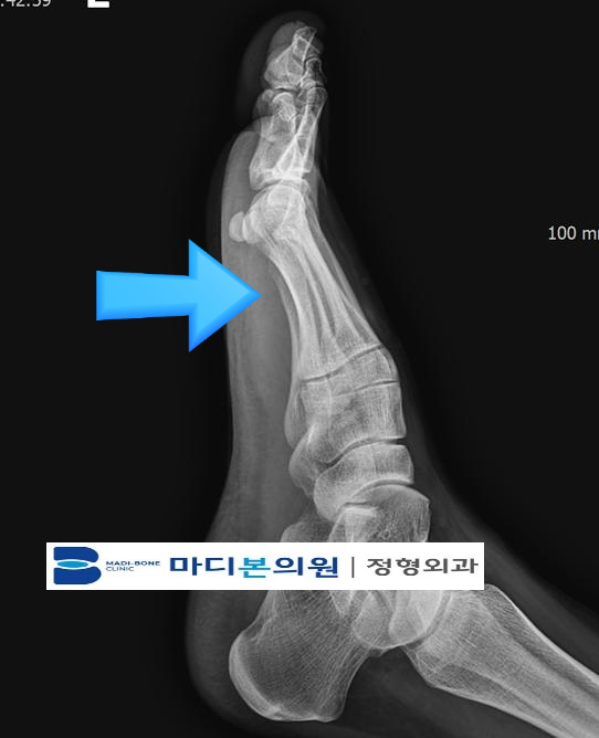 When the Front of Your Foot Hurts: Understanding Forefoot Plantar Pain se 2635125e aa7f 4ce2 956c 5e9d792ebe10
