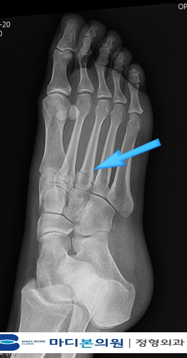 Why “Hidden Fractures” Appear Late After Winter Falls se c3124de5 0e5f 40f9 aa08 27affb4ea276