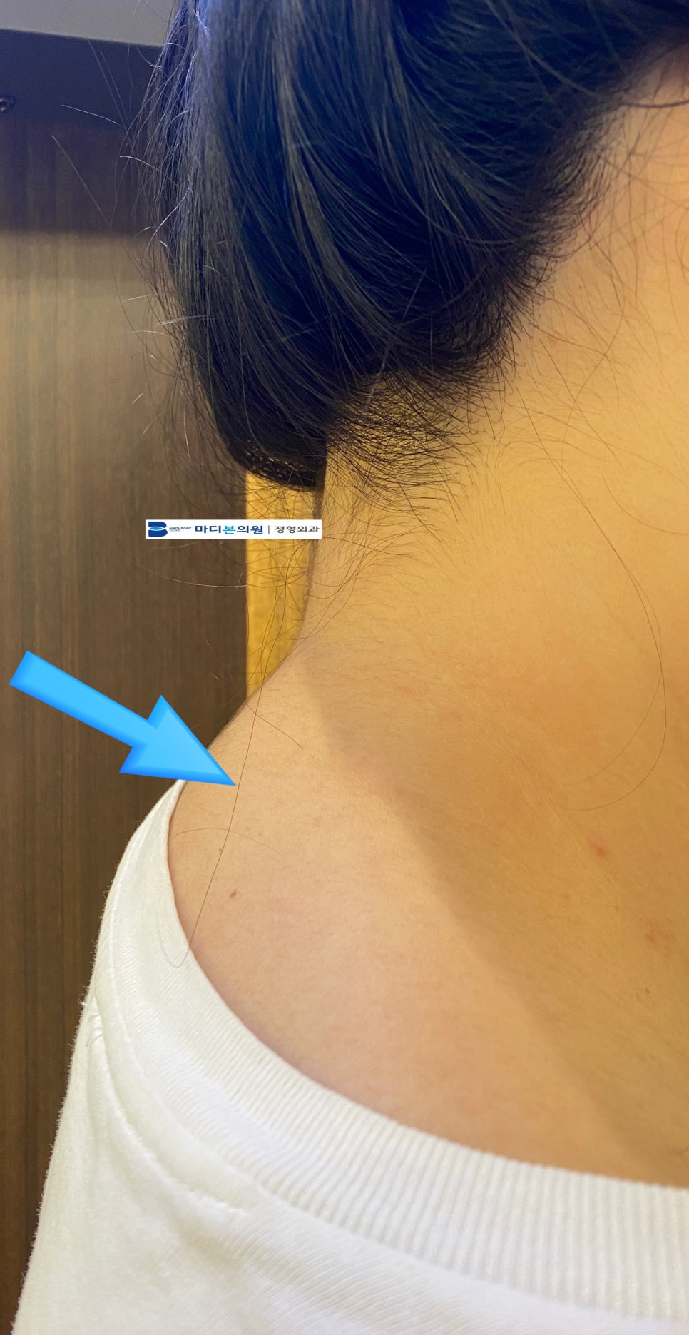 Beauty Check: How to Pinpoint a Neck Hump from Side Photos se ece2ecf6 513a 4269 9091 07afe462512f
