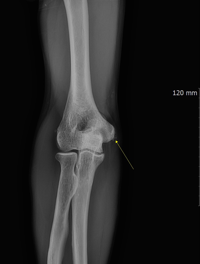 Calcific Tendinopathy: Not Just a Shoulder Problem 화면 캡처 2025 12 03 102037