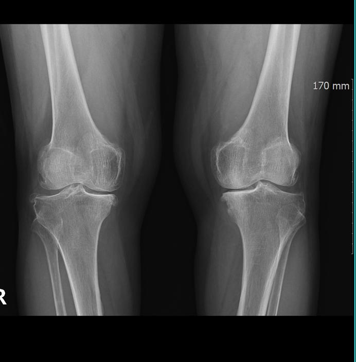 Early-Onset Knee Osteoarthritis: It Is Not Just for the Elderly Knee Osteoarthritis