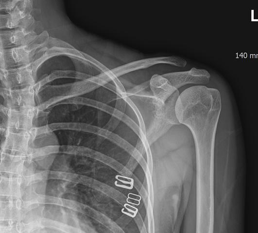 Frozen Shoulder: Why It Gets Worse Before It Gets Better Frozen Shoulder
